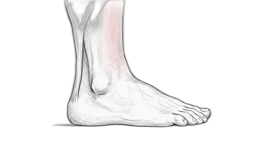 Shin Splints (Medial Tibial Stress Syndrome) — Lateral view