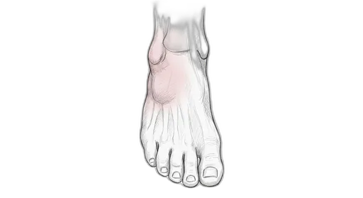 Sinus Tarsi Syndrome — Dorsal view