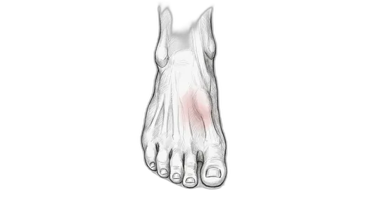 Stress Fracture